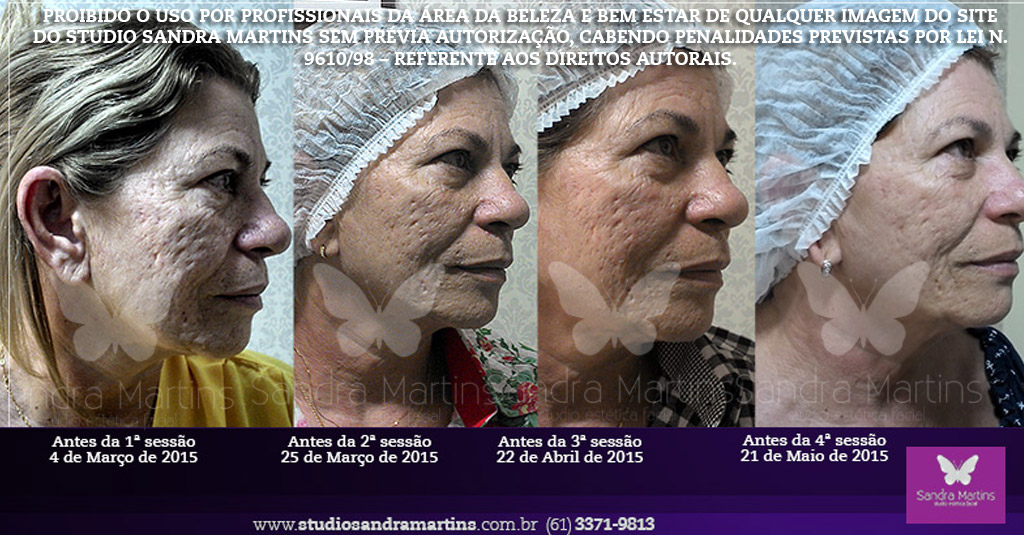 Microagulhamento, um procedimento estético que oferece a oportunidade de melhorar a aparência envelhecida por meio da redução de rugas, combate à flacidez facial, melhora da textura e aumento da luminosidade. Importante lembrar que o preço do microagulhamento