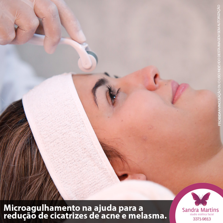 Quem sofre com manchas na pele e quer passar o verão de 2019 sem preocupações já tem uma eficaz alternativa de tratamento estético facial em Brasília: o microagulhamento.