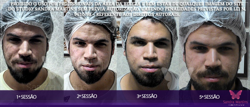 antes e depois clareamento, limpeza de pele, microagulhamento, dermaroller e rejuvenescimento Brasilia Sandra Martins