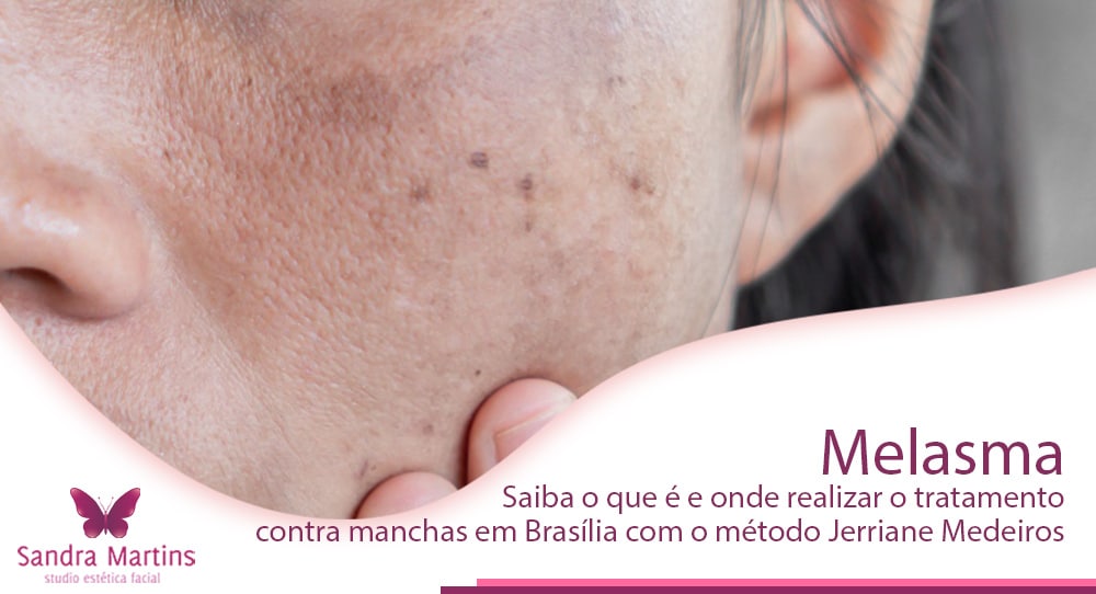 Melasma, a mancha que assombra as mulheres, saiba o que é e onde realizar o tratamento contra manchas em Brasília com o método Jerriane Medeiros
