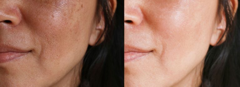 Microagulhamento com Dermaroller para Melasma e manchas em Brasília