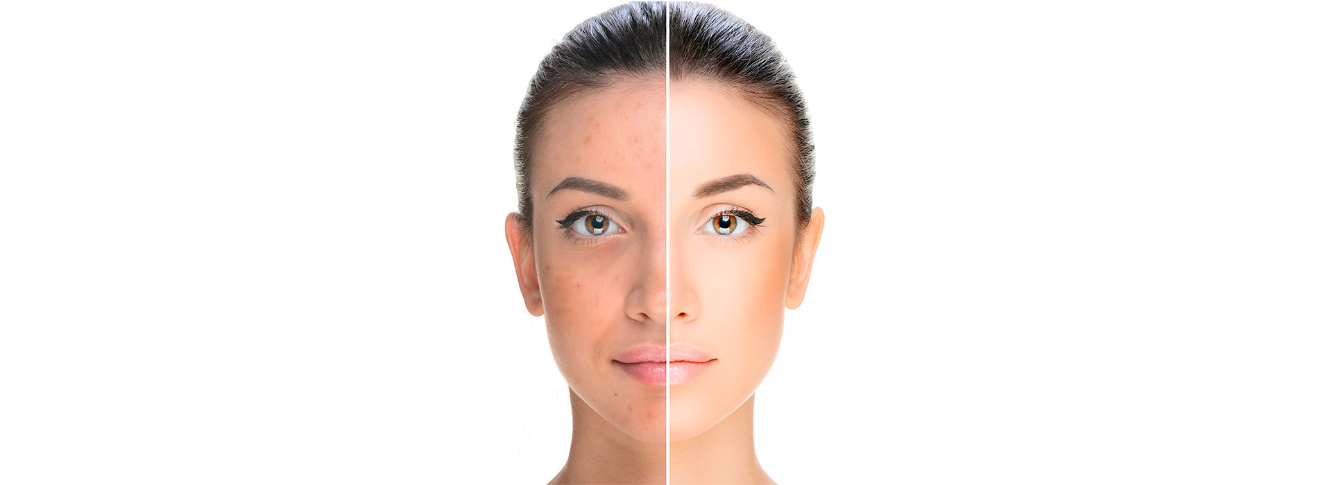 Os melhores tratamentos estética facial: limpeza de pele, cicatriz de acne, melasma, manchas, harmonização papada, pescoço e colo em Brasília