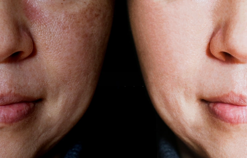 Quais os Melhores procedimentos para o Melasma que o Studio Sandra Martins indica
