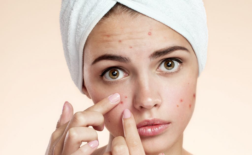 Mulheres têm quatro vezes mais chances de ter acne na fase adulta