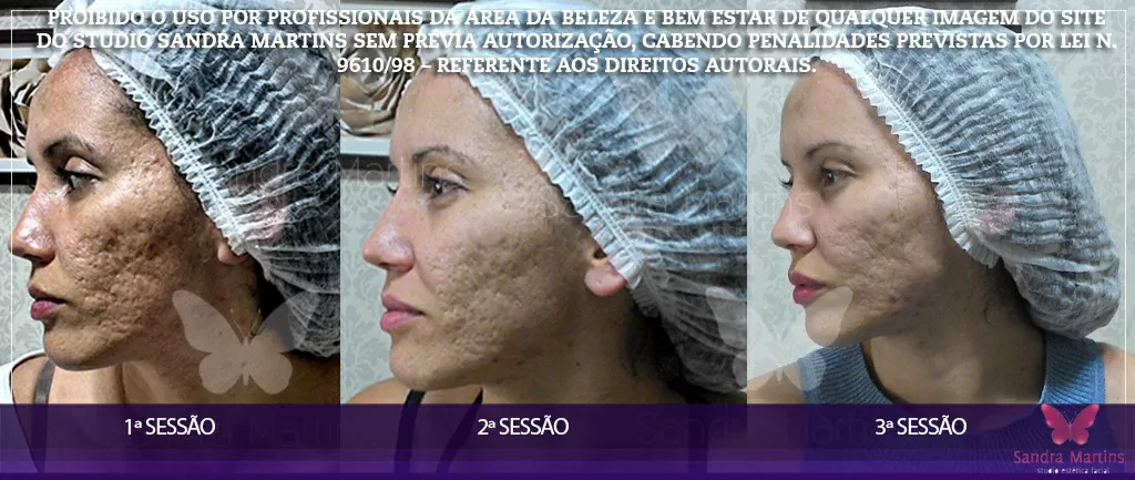 Confira alguns antes e depois de clientes que já realizaram tratamentos faciais com microagulhamento em Brasília do Studio Sandra Martins