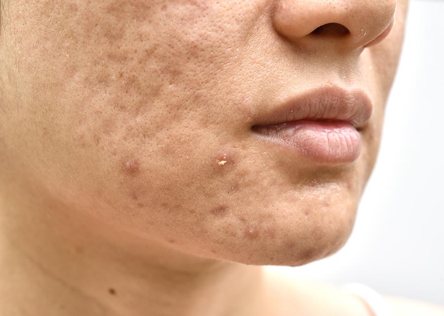 A cicatriz que vem da acne normalmente não some sozinha, e deve ser tratada com o uso correto de dermocosméticos em conjunto com sessões de microagulhamento.