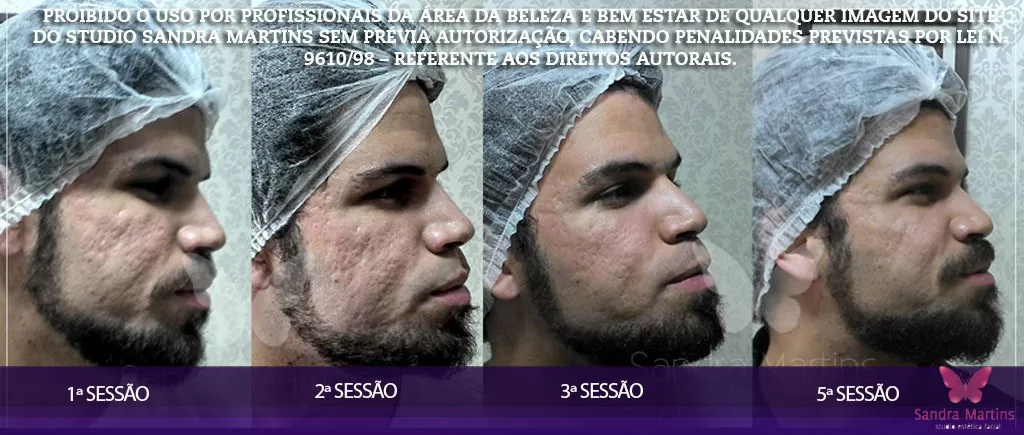 Confira alguns antes e depois de clientes que já realizaram tratamentos faciais com microagulhamento em Brasília do Studio Sandra Martins