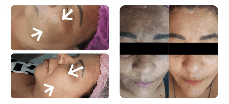 Clareamento de manchas de melasma, com blend de ácidos é no Studio Sandra Martins em Brasília, utilizando o programa de Clareamento Add Vulcan de Jerriane Medeiros. 