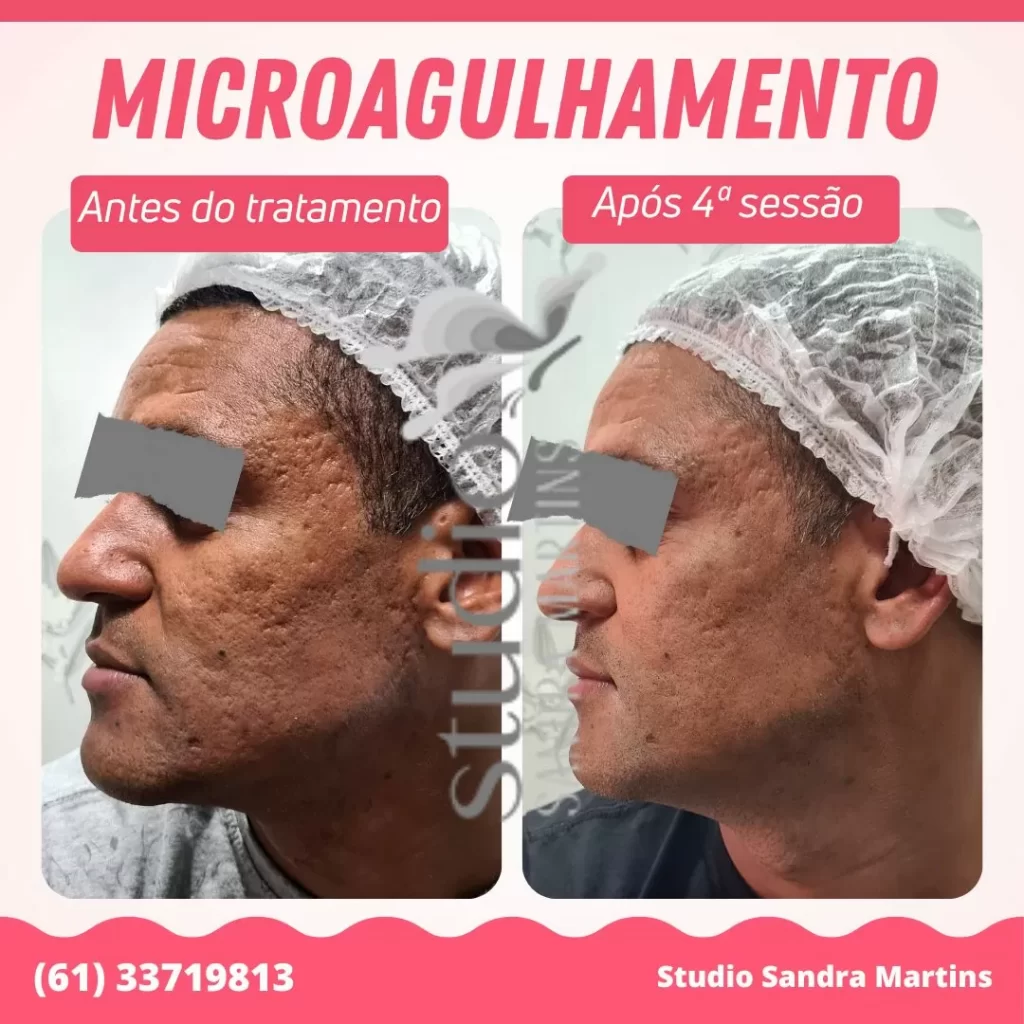 Sandra Martins é referência em resultados em tratamentos com microagulhamento em Brasília