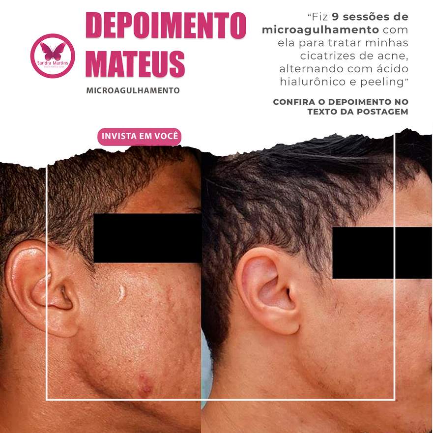 Microagulhamento em Taguatinga no tratamento do envelhecimento facial maio 17, 2024 Studio Sandra Martins de Estética Facial