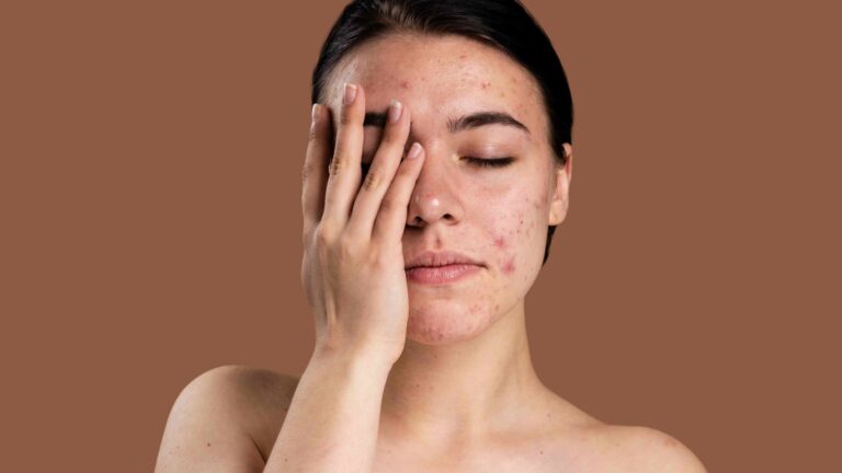 Acne na zona T ou na região U: entenda o motivo do aparecimento de espinhas e cravos em cada área do rosto com a Sandra Martins