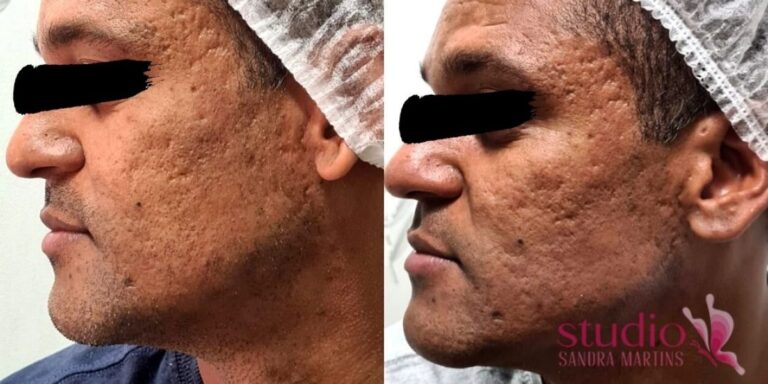 Microagulhamento antes e depois 1 sessão tem resultados em Taguatinga? Será se realmente isso é verdade?