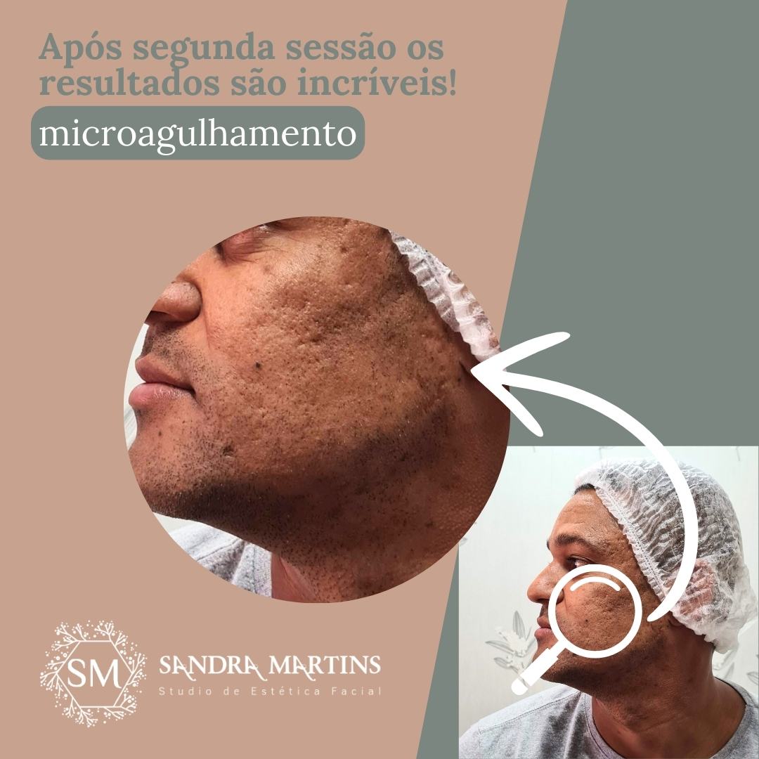 Microagulhamento antes e depois 1 sessão com resultados em Taguatinga no Studio Sandra Martins! Será se realmente isso é verdade? Confira os resultados da Sandra Martins na M Norte em Taguatinga Distrito Federal!

Você deve notar uma diferença na textura da pele uma semana após a primeira sessão. A maioria dos pacientes nota primeiramente uma redução no tamanho dos poros e melhora na luminosidade da pele e em longo prazo melhora das cicatrizes de acne, rugas e melasma. Abaixo temos um paciente que começa apresentar os primeiros resultados com apenas 1 sessão de microagulhamento.