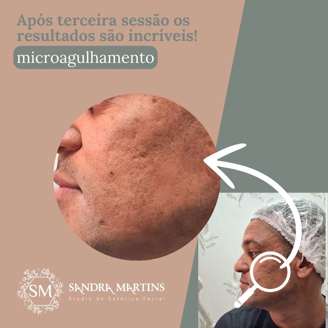Microagulhamento antes e depois 1 sessão com resultados em Taguatinga no Studio Sandra Martins! Será se realmente isso é verdade? Confira os resultados da Sandra Martins na M Norte em Taguatinga Distrito Federal!

Você deve notar uma diferença na textura da pele uma semana após a primeira sessão. A maioria dos pacientes nota primeiramente uma redução no tamanho dos poros e melhora na luminosidade da pele e em longo prazo melhora das cicatrizes de acne, rugas e melasma. Abaixo temos um paciente que começa apresentar os primeiros resultados com apenas 1 sessão de microagulhamento.