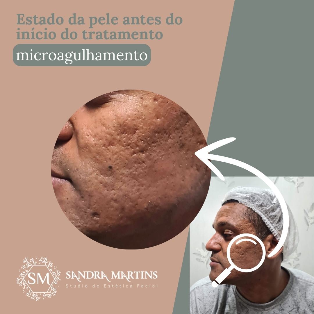 Microagulhamento antes e depois 1 sessão com resultados em Taguatinga no Studio Sandra Martins! Será se realmente isso é verdade? Confira os resultados da Sandra Martins na M Norte em Taguatinga Distrito Federal!

Você deve notar uma diferença na textura da pele uma semana após a primeira sessão. A maioria dos pacientes nota primeiramente uma redução no tamanho dos poros e melhora na luminosidade da pele e em longo prazo melhora das cicatrizes de acne, rugas e melasma. Abaixo temos um paciente que começa apresentar os primeiros resultados com apenas 1 sessão de microagulhamento.