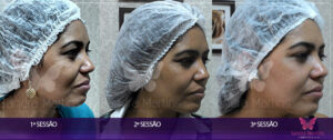 antes e depois rejuvenescimento facial Deseja rejuvenescer sua pele, suavizando rugas e recuperando a vitalidade? Ou quer prevenir o envelhecimento precoce e manter uma aparência radiante por mais tempo? No Studio Sandra Martins, oferecemos tratamentos de rejuvenescimento facial personalizados para todas as idades e necessidades. Se você busca reverter os sinais do tempo, como rugas, flacidez e manchas, combinamos técnicas avançadas como microagulhamento, peelings e fototerapia para um resultado natural e duradouro