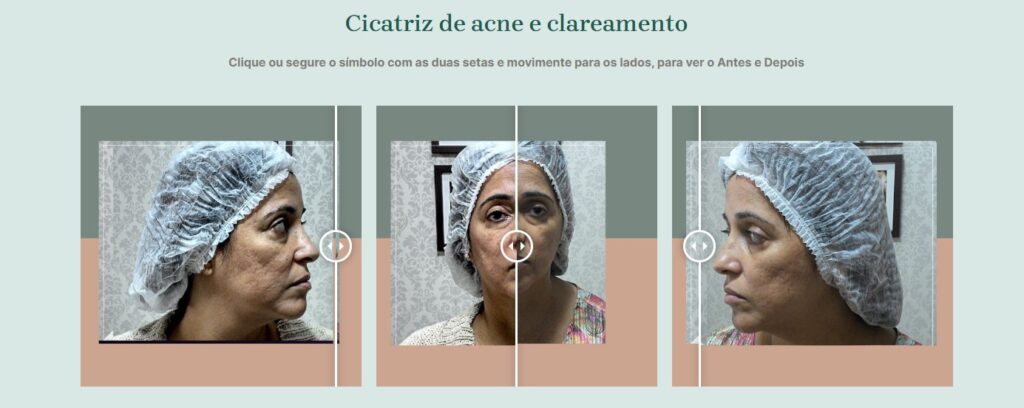 Após 15 anos dedicados a realçar a beleza natural de cada cliente, o Studio Sandra Martins, em Taguatinga, orgulhosamente apresenta seu novo website: uma plataforma moderna, intuitiva e completa, projetada para proporcionar uma experiência online excepcional. Este site, a quarta versão em nossa história, é o reflexo da nossa constante busca por inovação e excelência em estética facial. Mais que um site, é um convite para você se conectar com o universo do cuidado, do bem-estar e da transformação.