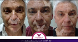 antes e depois rejuvenescimento facial Deseja rejuvenescer sua pele, suavizando rugas e recuperando a vitalidade? Ou quer prevenir o envelhecimento precoce e manter uma aparência radiante por mais tempo? No Studio Sandra Martins, oferecemos tratamentos de rejuvenescimento facial personalizados para todas as idades e necessidades. Se você busca reverter os sinais do tempo, como rugas, flacidez e manchas, combinamos técnicas avançadas como microagulhamento, peelings e fototerapia para um resultado natural e duradouro