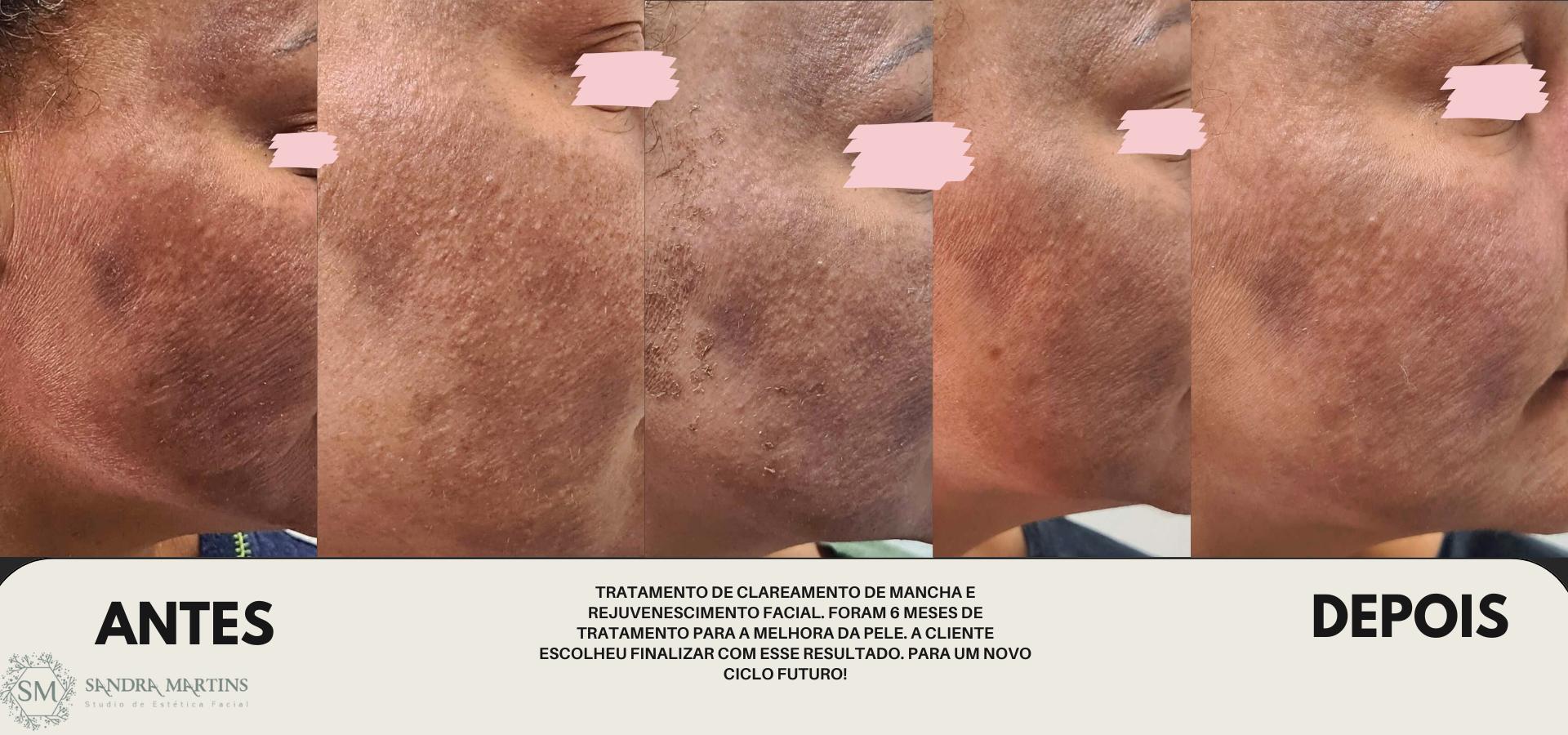 Acompanhar a jornada de transformação dessa cliente foi um privilégio. Durante seis meses, trabalhamos juntas no tratamento de clareamento de manchas e rejuvenescimento facial, e ver sua satisfação com a melhora na qualidade da sua pele é a minha maior recompensa. No Studio Sandra Martins em Taguatinga, acreditamos que a verdadeira beleza está na saúde e no bem-estar, e celebramos cada conquista individual.