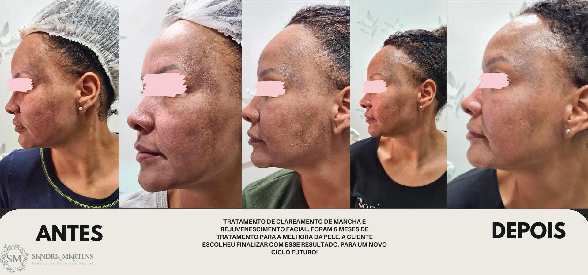 Acompanhar a jornada de transformação dessa cliente foi um privilégio. Durante seis meses, trabalhamos juntas no tratamento de clareamento de manchas e rejuvenescimento facial, e ver sua satisfação com a melhora na qualidade da sua pele é a minha maior recompensa. No Studio Sandra Martins em Taguatinga, acreditamos que a verdadeira beleza está na saúde e no bem-estar, e celebramos cada conquista individual.