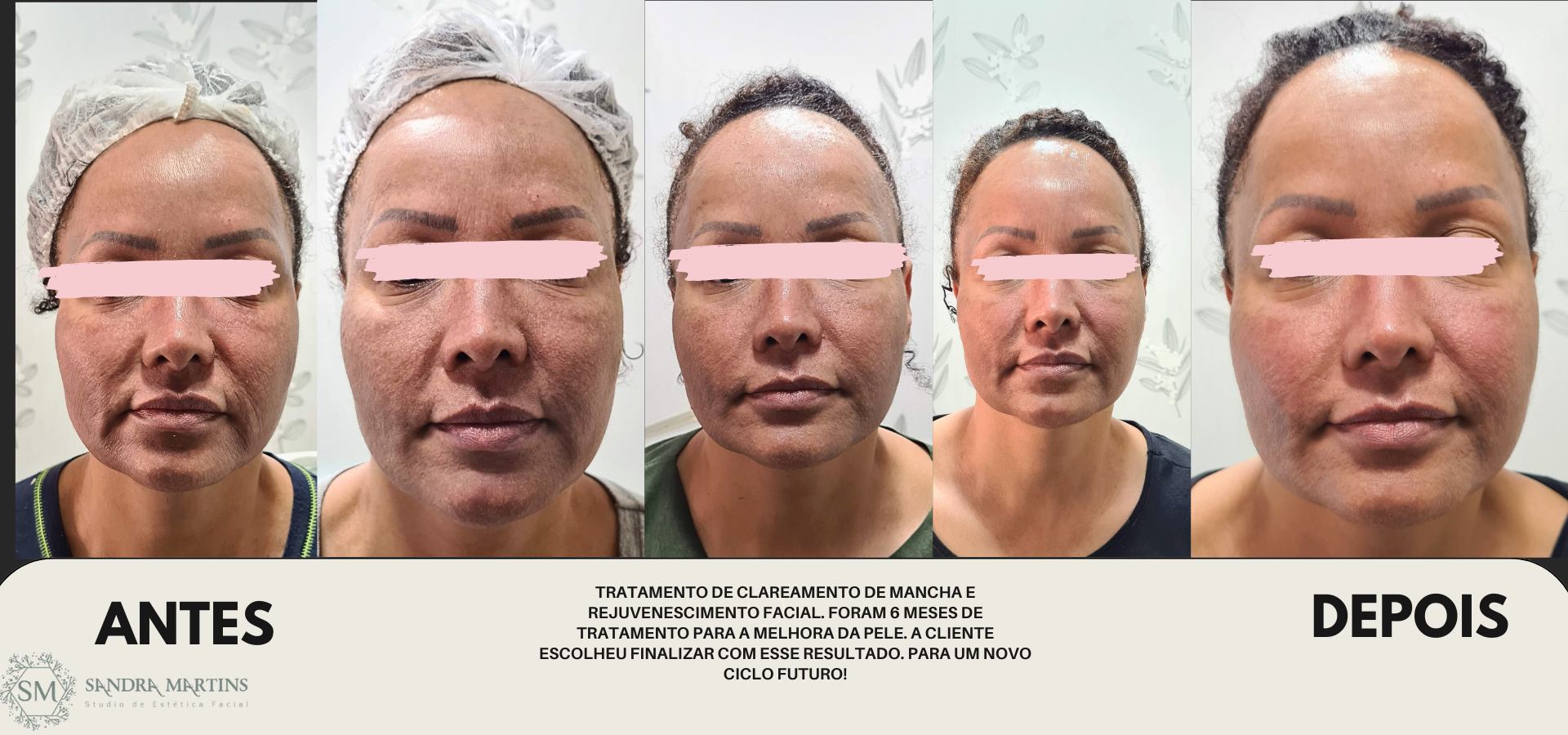 Acompanhar a jornada de transformação dessa cliente foi um privilégio. Durante seis meses, trabalhamos juntas no tratamento de clareamento de manchas e rejuvenescimento facial, e ver sua satisfação com a melhora na qualidade da sua pele é a minha maior recompensa. No Studio Sandra Martins em Taguatinga, acreditamos que a verdadeira beleza está na saúde e no bem-estar, e celebramos cada conquista individual.