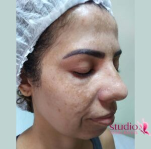 Peeling químico em Taguatinga para mancha de melasma Diga adeus às manchas escuras no rosto Com nosso tratamento exclusivo, em Taguatinga, para clarear manchas na pele do rosto de melasma, você pode ter uma pele uniforme e radiante em poucas sessões.