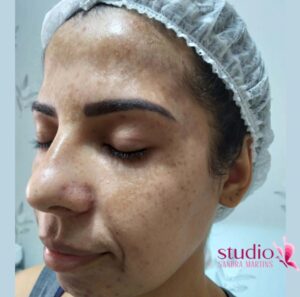 Peeling químico em Taguatinga para mancha de melasma Diga adeus às manchas escuras no rosto Com nosso tratamento exclusivo, em Taguatinga, para clarear manchas na pele do rosto de melasma, você pode ter uma pele uniforme e radiante em poucas sessões.