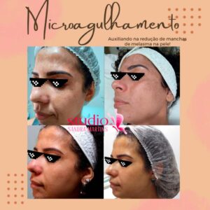 Sandra Martins é referência em resultados em tratamentos com microagulhamento em Brasília. O melhor microagulhamento de Taguatinga para cicatriz de acne e manchas