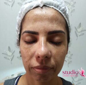 Peeling químico em Taguatinga para mancha de melasma Diga adeus às manchas escuras no rosto Com nosso tratamento exclusivo, em Taguatinga, para clarear manchas na pele do rosto de melasma, você pode ter uma pele uniforme e radiante em poucas sessões.