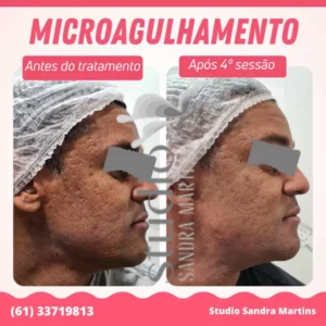 Sandra Martins é referência em resultados em tratamentos com microagulhamento em Brasília. O melhor microagulhamento de Taguatinga para cicatriz de acne e manchas