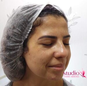 Peeling químico em Taguatinga para mancha de melasma Diga adeus às manchas escuras no rosto Com nosso tratamento exclusivo, em Taguatinga, para clarear manchas na pele do rosto de melasma, você pode ter uma pele uniforme e radiante em poucas sessões.