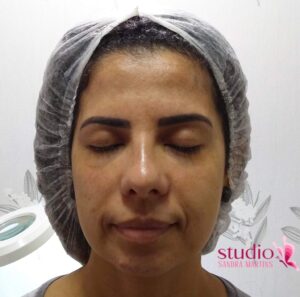 Peeling químico em Taguatinga para mancha de melasma Diga adeus às manchas escuras no rosto Com nosso tratamento exclusivo, em Taguatinga, para clarear manchas na pele do rosto de melasma, você pode ter uma pele uniforme e radiante em poucas sessões.