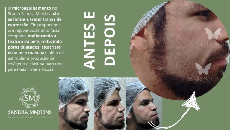 Sandra Martins é referência em resultados em tratamentos com microagulhamento em Brasília. O melhor microagulhamento de Taguatinga para cicatriz de acne e manchas