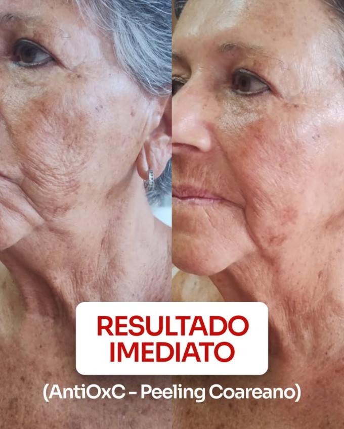 Peeling Coreano LHA em Brasília com 45% de Vitamina C no Studio Sandra Martins Conquiste a Pele de Porcelana dos Seus Sonhos em Brasília: Peeling Coreano LHA com 45% de Vitamina C no Studio Sandra Martins Olá! Sou Sandra Martins. Em meus 15 anos dedicados à estética facial avançada aqui em Brasília, acompanhei mais de 4000 jornadas de transformação da pele. Percebo em minhas clientes um desejo crescente: uma pele radiante, uniforme, com textura impecável e aquele glow saudável – muitas vezes inspirado nos ideais de beleza coreanos, a famosa “pele de vidro” ou “pele de porcelana”. Ao mesmo tempo, vejo a hesitação em relação a tratamentos que prometem renovação, mas trazem consigo o receio de irritação, descamação intensa e a necessidade de se esconder do sol.