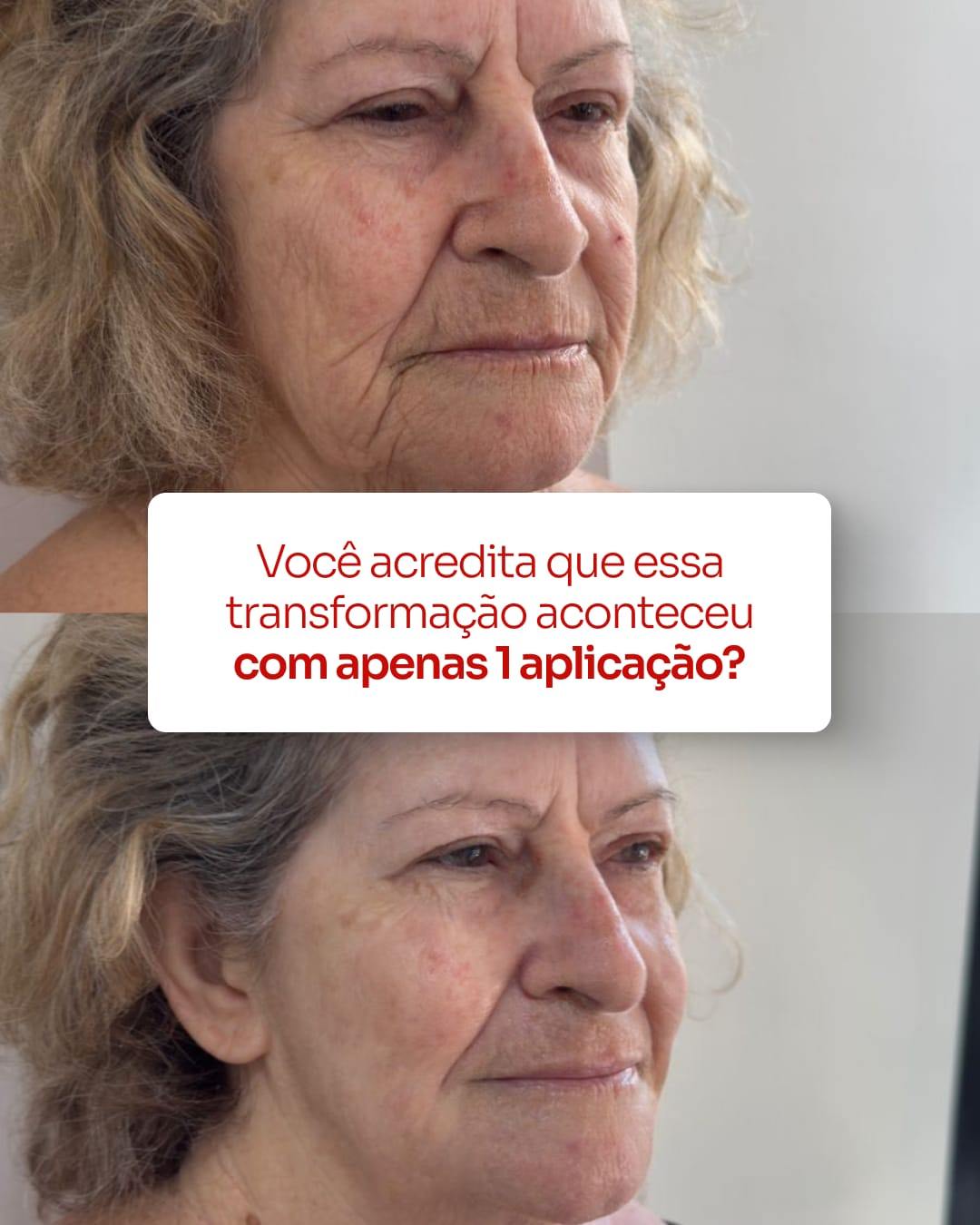 Peeling Coreano LHA em Brasília com 45% de Vitamina C no Studio Sandra Martins Conquiste a Pele de Porcelana dos Seus Sonhos em Brasília: Peeling Coreano LHA com 45% de Vitamina C no Studio Sandra Martins Olá! Sou Sandra Martins. Em meus 15 anos dedicados à estética facial avançada aqui em Brasília, acompanhei mais de 4000 jornadas de transformação da pele. Percebo em minhas clientes um desejo crescente: uma pele radiante, uniforme, com textura impecável e aquele glow saudável – muitas vezes inspirado nos ideais de beleza coreanos, a famosa “pele de vidro” ou “pele de porcelana”. Ao mesmo tempo, vejo a hesitação em relação a tratamentos que prometem renovação, mas trazem consigo o receio de irritação, descamação intensa e a necessidade de se esconder do sol.