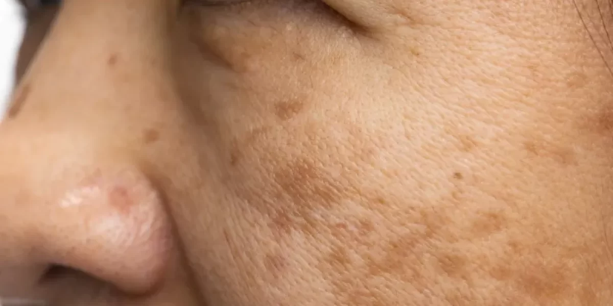 Melanose solar entenda o surgimento das manchas na pele aos 50 anos