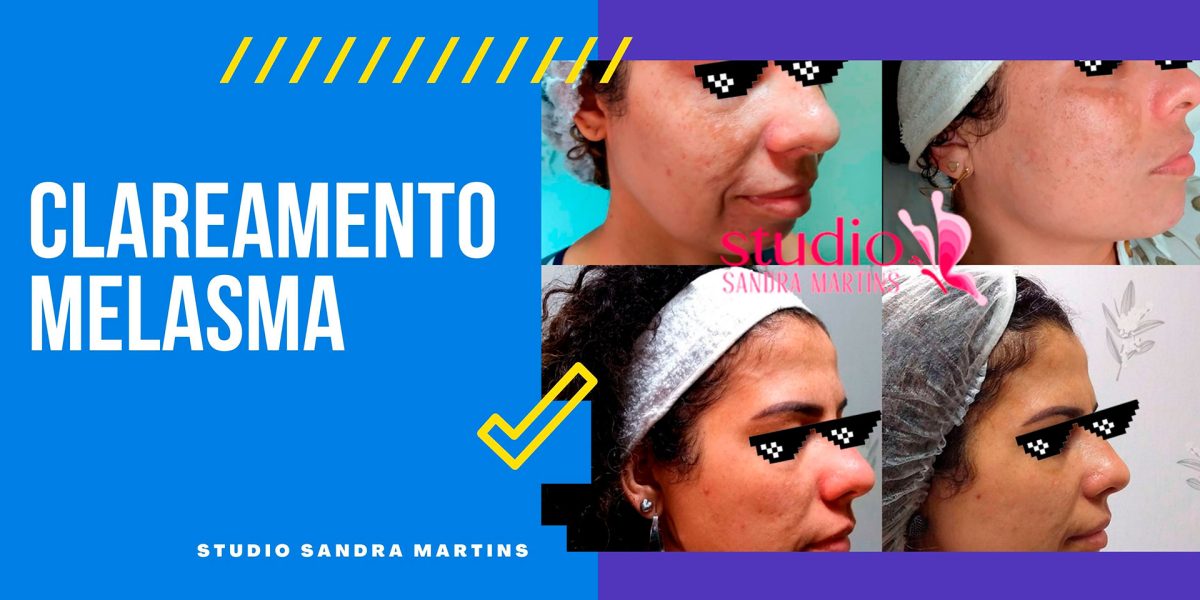 Precisa clarear a pele do rosto? Clareamento de mancha e melasma em Brasília com uso de blend de ácidos em Brasília! Agendamento 3371-9813