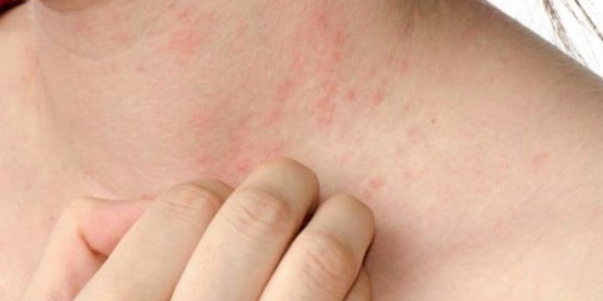 Pesquisa de opinião, sobre a dermatite, encomendada pela Pfizer mostra que ainda há muita desinformação sobre a condição dermatológica 